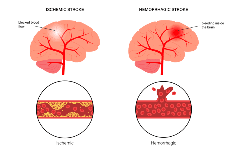 Bezobjawowa hiperurykemia - niedoceniana przyczyna udaru mózgu i zawału serca