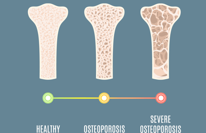 Osteoporoza - cicha choroba kości