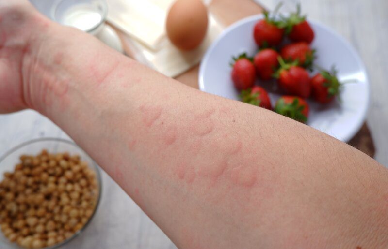 Najczęstsze alergeny pokarmowe u ludzi