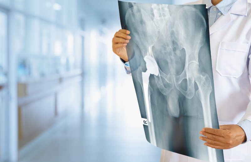 Światowy Dzień Chorych na Osteoporozę – Nie daj się złamać osteoporozie